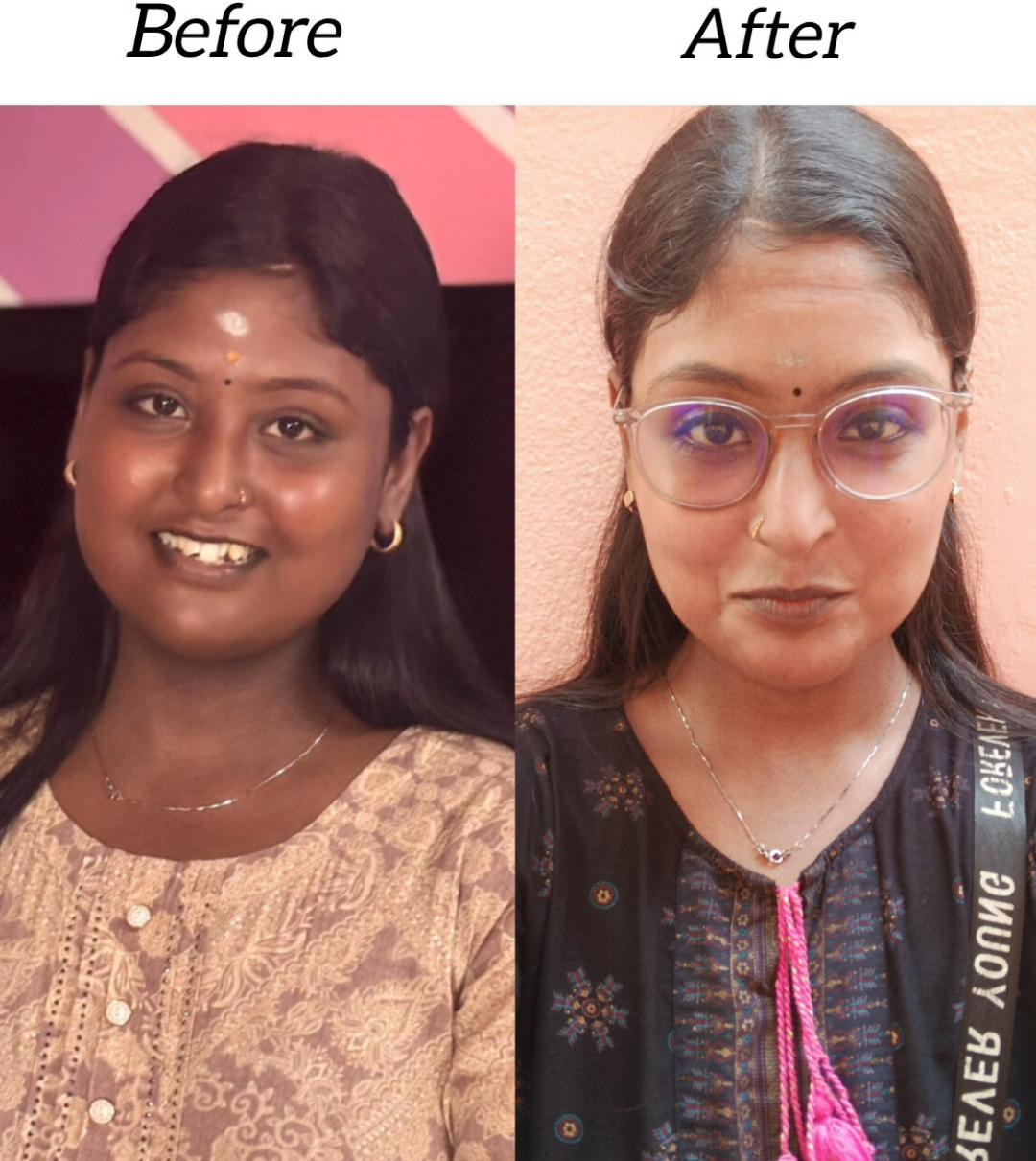 After — Sun Tan Reversed