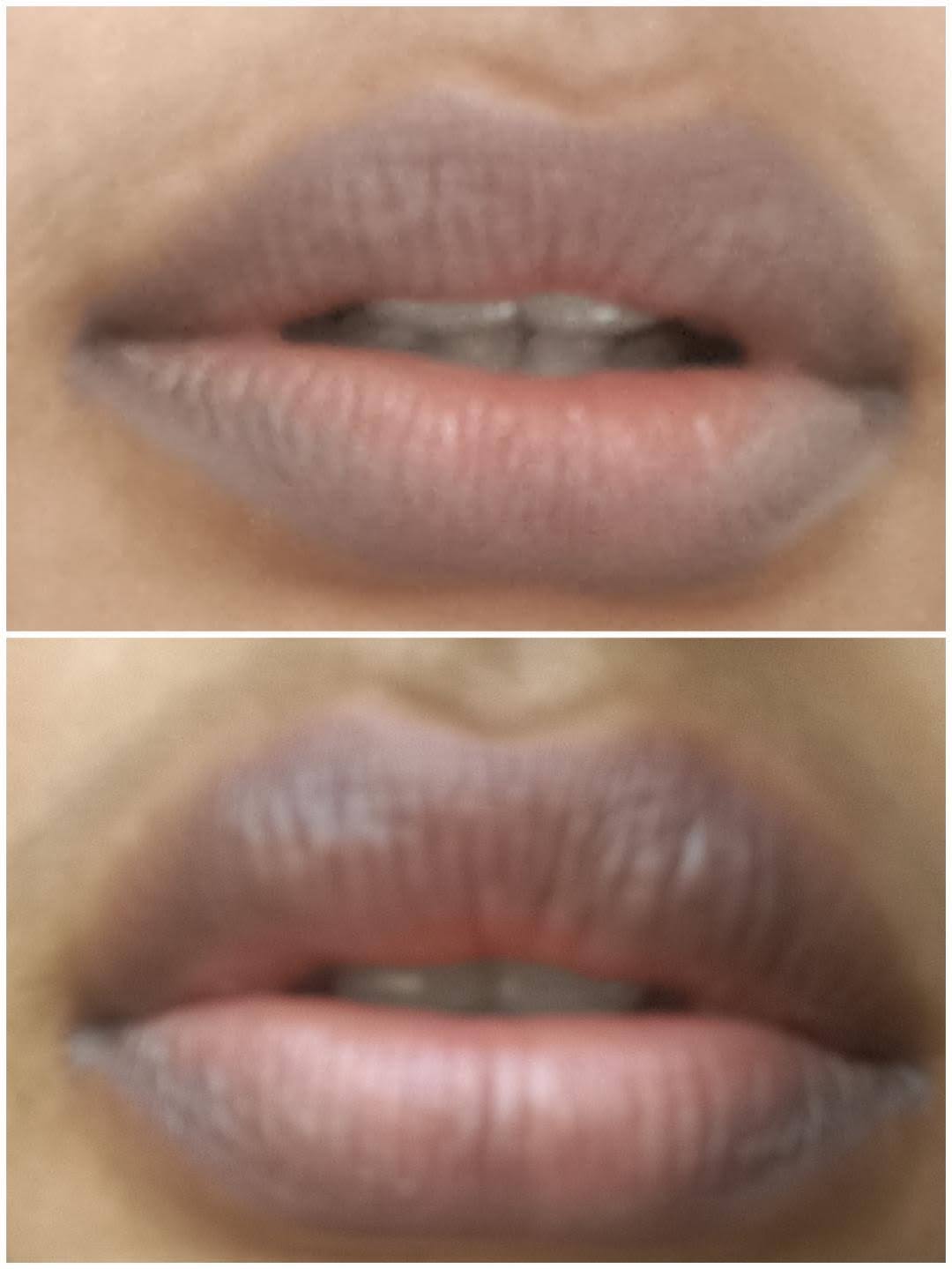 Upper & Lower Lip Tone Equalization